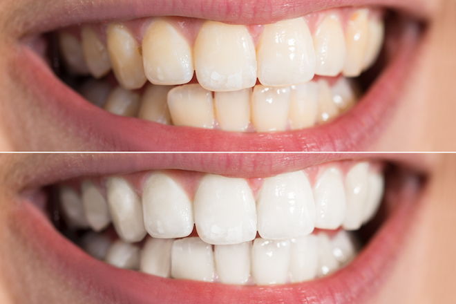 Faccette dentali: descrizione, vantaggi, durata e costi