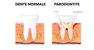 riconoscere_la_parodontite